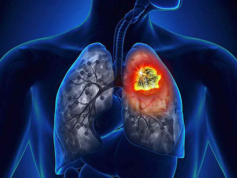 Screening de câncer de pulmão